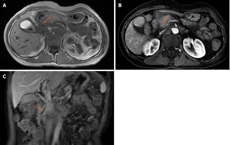 Magnetic resonance imaging of the abdomen. A and B: The wall of the common bile duct was thickened (arrows) and became obviously enhanced with contrast agent; C: Local nodular thickening was seen in the lower segment of the common bile duct (arrow).