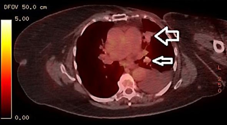 PET demonstrated multiple lesions in the lingular left lung. The arrows point at ‘hot nodules’ found to be metastatic breast cancer in the left lung.