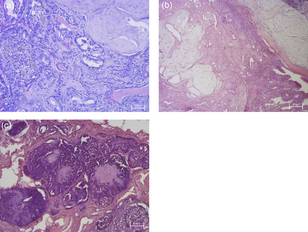 Histopathological characterisation in tissues of canine mammary carcinoma (CMC). (a) Malignant epithelial cells showing solid or tubulopapillary growth patterns, hypochromic nuclei and prominent nucleoli (haematoxylin and eosin [H&E], 20×). (b) Biphasic tumour structure showing neoplastic epithelial cells associated with benign myoepithelial components and metaplastic cartilage (H&E, 10×). (c) Area of comedocarcinoma characterised by neoplastic cells surrounding central necrotic and apoptotic zones (H&E, 10×).