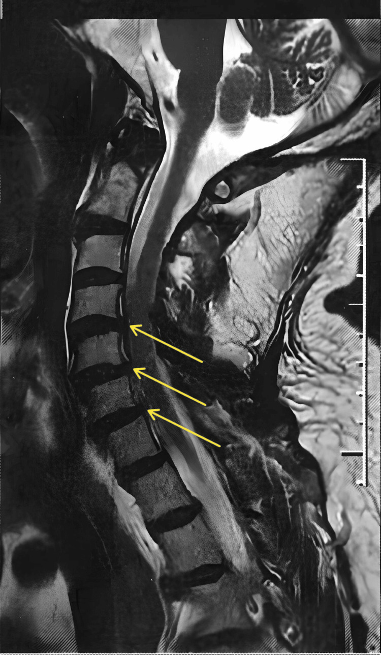 Magnetic resonance imaging of the cervical spine showing spondyloarthrosis, highlighting mild stenosis of the spinal canal at C4-C5 and C5-C6 and stenoses of the left neural foramina at C3-C4, C4-C5, C5-C6, and C6-C7