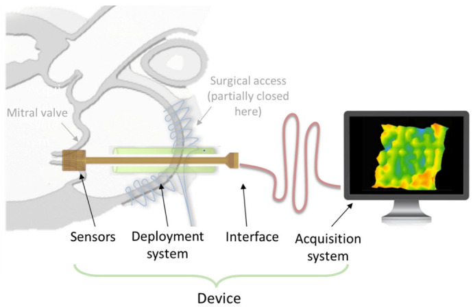 Working principle of the biosensor device used for force measurement of mitral valve coaptation.