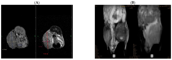 Comparative aspects between axial images (A) and 3D reconstruction (B) of the breast tumor in both T1 (left) and T2 (right) at the end of the experiment. These images highlight the position and burden of the tumor and its overall relationship with the surrounding tissues. Axial images offer greater information regarding the tumor margins and consistency, whereas 3D reconstruction is more accurate in emphasizing the tumor’s overall compressive aspect and relationship with neighboring anatomical structures. Acquisition of whole-body MRI images was performed using 1T PET/MRI (nanoScan®, Mediso Medical Imaging Systems, Budapest, Hungary).