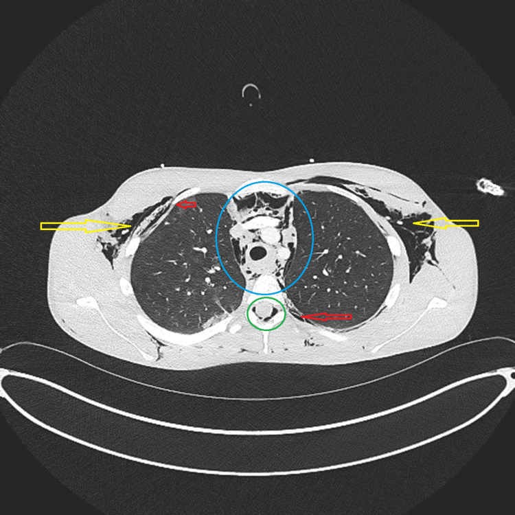 Contrast-enhanced CT chestAxial CT image demonstrating extensive subcutaneous emphysema (yellow arrows) and pneumomediastinum (blue circle). Pneumorrhachis is visible (green circle), and pneumothorax is highlighted (red arrows).