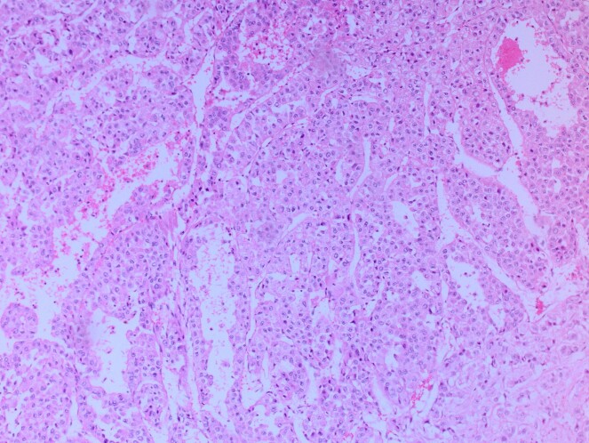Microscopic image with H&E staining shows the tumor cells.