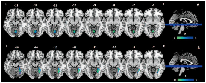 Post-hoc test of drug effects on the fractional amplitude of low-frequency fluctuations within each region of interest (cannabidiol > placebo) in autism spectrum disorder. (A) Drug effects within the cerebellar vermis IV; (B) drug effects within the right fusiform gyrus. Numbers above the slices indicate location in z-direction (in millimetres). Scans are oriented in neurological convention, where right (R) equals right, and left (L) equals left. P values (P), as indicated by the colour bar, are corrected for multiple comparisons (TFCE, FWE).
