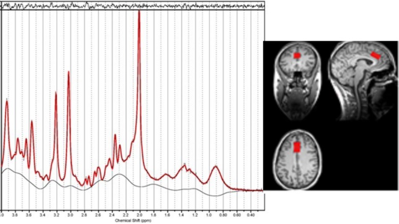 An example of the location of the voxel for Magnetic resonance spectroscopy (MRS) in the dorsal anterior cingulate along with the resultant spectrum processed by LCModel. The fitted spectrum (red) is superimposed on the original spectrum (black); the residual of fitting is on the top while the baseline is at the bottom. The linewidth is 0.033 ppm.