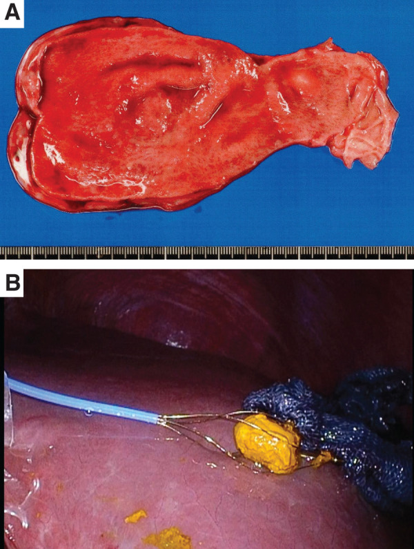 Resected specimens. (A) Gallbladder and (B) common bile duct stone measuring 18 mm in diameter.