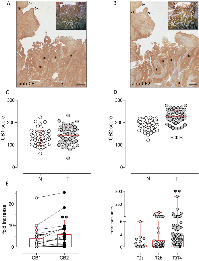 Expression of CB in human BCa.Representative immunoreactivity (black scale bars: 500 μm) of cannabinoid CB1 (panel A) and CB2 (panel B) receptors from a representative patient with muscle invasive bladder carcinoma. Image insets are lower magnification of the representative sample to evidence muscle-infiltrating tumor specimen (white scale bars: 2 mm). Tumour lesion (asterisk) and normal urothelium (arrows) are indicated. Formalin-fixed paraffin-embedded sections from 53 different tumour specimens stained with haematoxylin and CB1 and CB2 antibodies (DAB) were analyzed with the Color Deconvolution analysis tool to quantify the DAB staining intensity. Staining score of CB1 (panel C) and CB2 (panel D) receptors were measured on the tumour lesion (T, grey symbols) and normal epithelium (N, white symbols) of 53 different patients in duplicate slides. Data are shown individual values. The mean ± sd is shown. ***p < 0.001 vs normal tissue, Paired Student t-Test. Control staining in the presence of displacing CB1 and CB2 peptides are shown in Suppl. Fig. 1. Panel E: CB1 and CB2 gene expression analysis of primary muscle invasive BC frozen specimens (N = 19) compared to paired healthy tissue (dashed line) by quantitative PCR analysis. Data are represented as fold-increase values depicted both as individual values (mean of quadruplicates) of matching CB1-CB2 expression and as mean ± sd. **p < 0.01 vs CB1, Paired Student’s T test. Panel F: in silico analysis of the expression of CB2 receptors in primary muscle-invasive bladder cancers. Data are expressed as individual values and box-and-whiskers plots encompassing 28 samples of T2a tumours, 37 samples of T2b tumours, and 137 samples of T3T4 tumours. Error bars represent the max value in each group. **p = 0.0015, 1-way Kruskal-Wallis ANOVA with Dunn’s multiple comparison post test.