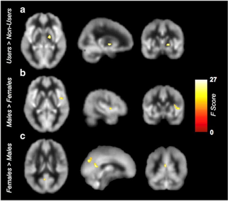 Results of cerebral blood flow (CBF) voxel-based comparisons superimposed on average CBF map of all participants. (a) The cannabis users showed higher CBF in right pallidum compared with nonusers. (b) Males showed higher CBF in the right insula, whereas (c) females showed higher CBF in the right posterior cingulate cortex and bilateral precuneus (FWE cluster level corrected at p<0.05).