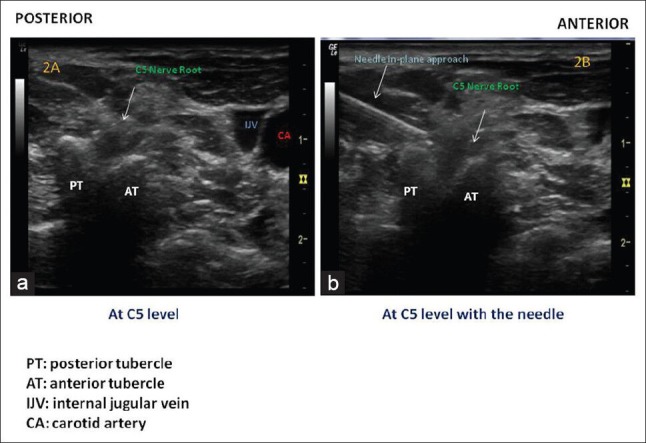 (a) Identification of C5 nerve root with important vascular structures visualised in the medial aspect. (b) C5 nerve root between the “camel humps” formed by anterior and posterior tubercles - with the needle approaching from posterior