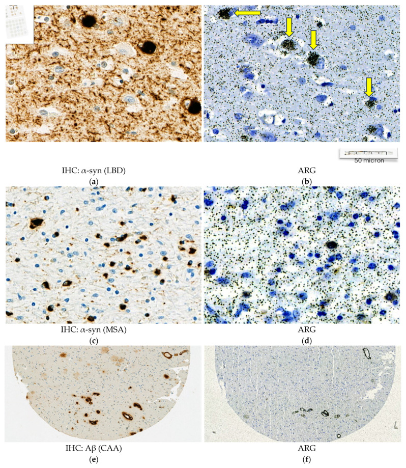 Representative high magnification images from α-synuclein (α-syn), amyloid beta (Aβ) and, phospho-tau (p-tau) immunohistochemistry (IHC) and emulsion autoradiography (ARG) with 25 nM [3H]GMC-058. (a–d) In two representative LBD (a,b) and MSA cases (c,d), the ARG signal (yellow arrows) corresponds to Lewy bodies (a) and oligodendrocytic inclusions (c). (e,f) In CAA cases, the ARG signal corresponds to dense perivascular Aβ deposits (e). (g–j) In PSP (g,h) and CBD (j,k), the ARG signal seems to localize in areas of p-tau positive inclusions (g,i). (k,l) In AD the case with abundant Aβ plaques and p-tau inclusions (k), a weak ARG signal was observed (l).