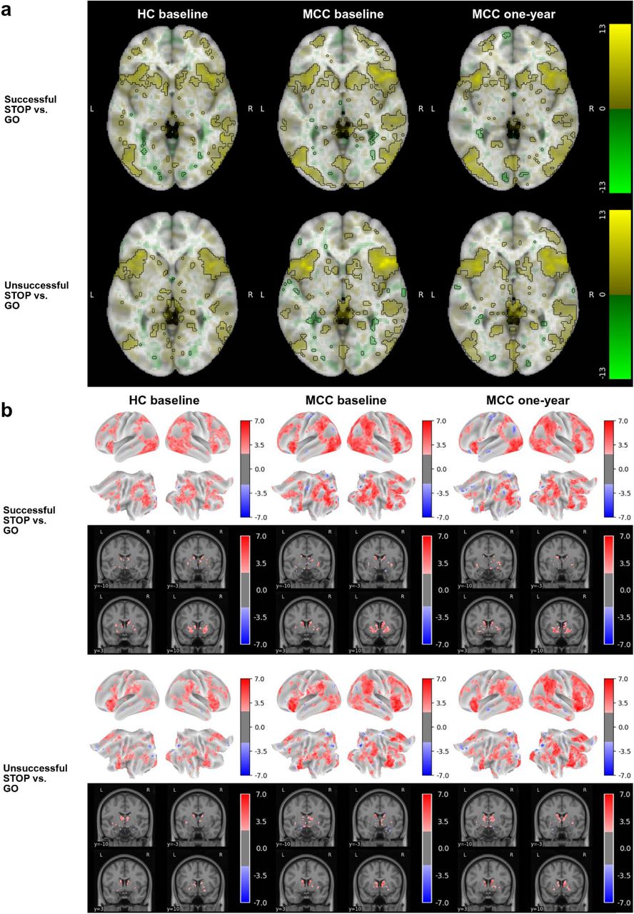 Brain activation for the SST task’s two STOP vs. GO contrasts across groups and timepointsThe HC group at baseline (n=25), the MCC group at baseline (n=40), and the MCC group at one-year (n=44) did not show activation differences between the two groups at baseline or between the two time points of the MCC group. Cannabis use frequency changes were not associated with brain activation at one-year. Figure 3a: Voxel-wise average brain activation, colored by effect size and opacity-scaled by z-scores with significance threshold (FDR=0.05) outlined, for the successful STOP vs. GO contrast (top row) and the unsuccessful STOP vs. GO contrast (bottom row) for the SST task. z-thresholds: HC group at baseline=2.77 (top) and 2.87 (bottom); MCC group at baseline=2.56 (top) and 2.62 (bottom), and MCC at one-year=2.62 (top) and 2.55 (bottom). Colorbar displays effect size. Figure 3b: Grayordinate-wise average brain activation z-scores above significance threshold (FDR=0.05) for the successful STOP vs. GO contrast (top row) and the unsuccessful STOP vs. GO contrast (bottom row) for the SST task. z-thresholds: HC group at baseline=2.25 (top) and 2.31 (bottom); MCC group at baseline=2.15 (top) and 2.20 (bottom), and MCC at one-year=2.22 (top) and 2.13 (bottom). Colorbar displays z-scores. HC=healthy control; MCC=medical cannabis card.