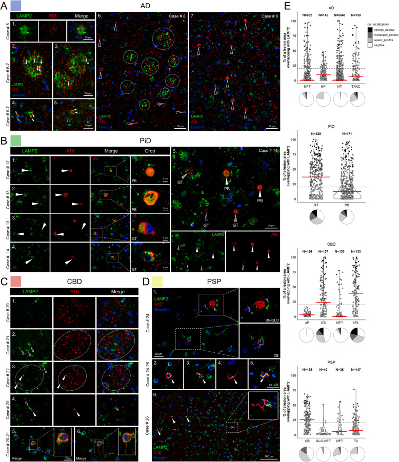 LAMP2 colocalizes with neuritic AD inclusions, Pick bodies and oligodendroglial coiled bodies in CBD and PSP frontal cortex. A In AD grey matter tissue, LAMP2 fluorescence delineated assemblies of engorged lysosomes, displaying spherical clusters of variably enlarged LAMP2-positive vesicles partially co-localized with phospho-tau structures (series 1–3, white arrowheads indicate co-localization). This abnormal and disease-specific distribution of LAMP2 protein in AD was reminiscent of AD NP pathology and was in proximity to AT8-positive NPs (series 2–3). Small TANCs and threads were also associated with LAMP2 (series 4–5). The robustness of both the distribution of LAMP2 clusters and to neuritic AD plaques can be observed in wide-view tile scans (series 6, white arrowheads) whereas NFT and NT pathology were mostly negative for LAMP2 signal (series 6, unfilled arrowheads). B PiD neuropathology showed LAMP2 accrual in the cores of grey matter PBs (series 1–2) and GTs found in the white matter (series 3–4). On the grey/white matter boundary LAMP2 was found within some GT lesions but not all (series 5, unfilled arrowheads—not colocalized, gray arrowheads –partially co-localized). C APs in CBD cases did not markedly sequester LAMP2 (series 1–3). Yet with larger and more mature APs, an increased presence of AT8 negative and LAMP2 laden cells was noted in addition to some small points of co-localization (series 2–3, open and white arrowheads, respectively). Small AT8 phospho-tau structures in CBD cases (SPLs) were associated with LAMP2 (series 4). Oligodendroglial inclusions were decorated with LAMP2 vesicles across CBD cases (series 5). D Neuronal PSP tau pathology (GLO NFTs) predominantly did not co-localize with LAMP2 (1, unfilled arrowheads). Some PSP TAs (series 3, 6) and CBs (series 1–2, 4–5) were weakly positive for LAMP2 signal across PSP cases. E Quantification of LAMP2-positive phospho-tau lesions from n = 3 cases/tauopathy showing the relative area of overlap between AT8 and LAMP2 in tauopathy lesions. Modified violin plots with data points show individual lesions plotted against relative overlap area. Lesions are categorized into co-localization categories based on their relative area of overlap. Red lines indicate median values. Pie charts underneath the violin plots illustrate the relative proportions of lesions with different degrees of co-localization. Abbreviations: LAMP2, lysosome-associated membrane glycoprotein 2; AD, Alzheimer’s disease; PiD, Pick’s disease; CBD, corticobasal degeneration; PSP, progressive supranuclear palsy; NFTs, neurofibrillary tangles; TANCs, tangle-associated neuritic clusters; APs, astrocytic plaques; CBs, coiled bodies; PBs, Pick bodies; GT, glial tau; NTs, neuropil threads; NP, neuritic plaque; SPL, small phospho-tau lesions; TA, tufted astrocytes; GLO-NFT, globose NFTs