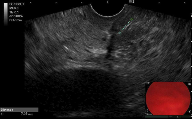 Endoscopic ultrasound image showing a sharp hyperechoic linear object traversing the bile duct.
