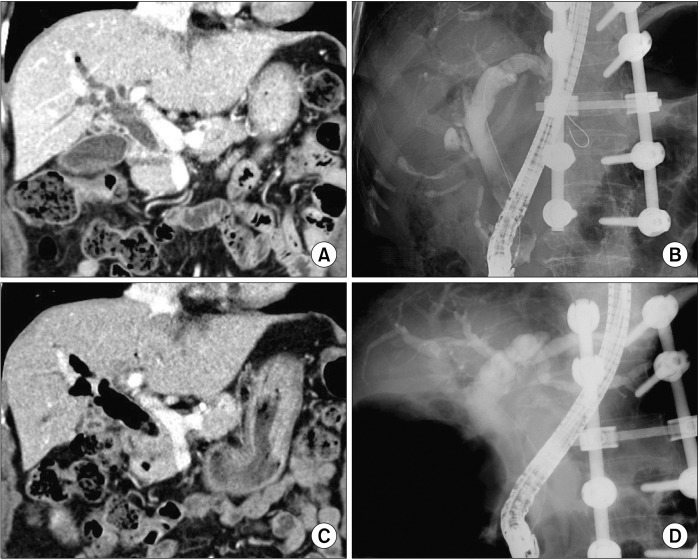 The preoperative finding of Case No. 1. Computed tomo-graphy (CT) and endoscopic retrograde cholangiopancreato-graphy (ERCP) taken 7 years before surgery (A, B) show marked dilatation of the com-mon bile duct with the patulous sphincter. CT scan and ERCP taken 1 month before surgery (C, D) show further dilatation of the common bile duct filled with air and sludges, indicating reflux ascending cholangitis. The spine was externally fixed 11 years before due to spine fracture.