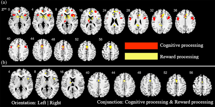 Additional analysis aimed at determining the contribution of the cognitive and reward‐based task paradigms for the main meta‐analysis across all substances. (a) ALE peak maps for the common (conjunction contrast) and differential (subtraction contrast) between the two types of task paradigms. Red (cognitive processing tasks > reward processing tasks); Yellow (reward processing tasks > cognitive processing tasks). (b) between the two types of task paradigm. Displayed at FWE < 0.05