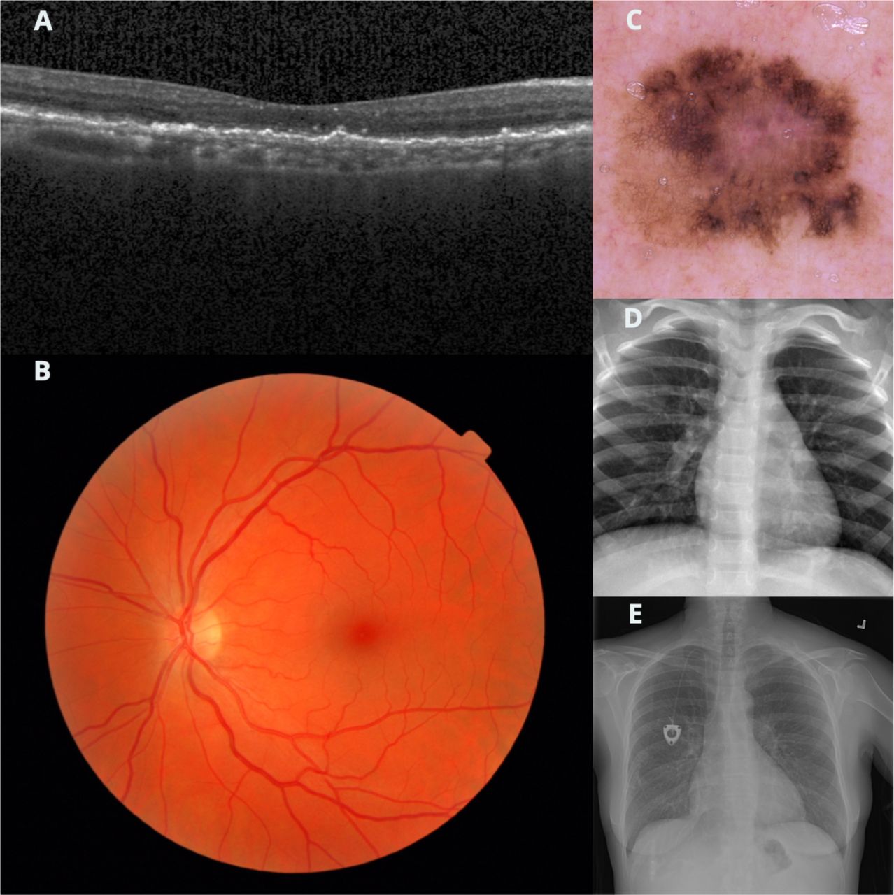 Cases from each model where the incorrect label was predicted.(A) Case of drusen, which was predicted as neovascular age-related macular degeneration. (B) Presence of diabetic retinopathy predicted as normal. (C) A melanoma predicted as a nevus. (D) Pneumonia predicted as normal. (E) A pleural effusion predicted as normal. Case B does not have detectable features of its label while E is equivocal.
