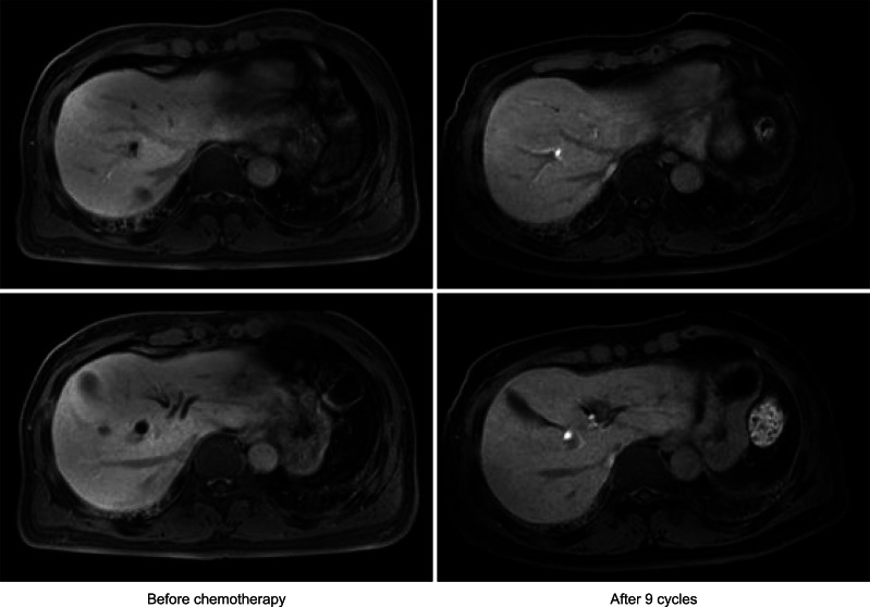 Liver magnetic resonance imaging shows complete regression of multifocal hepatic nodules after nine cycles of chemotherapy.