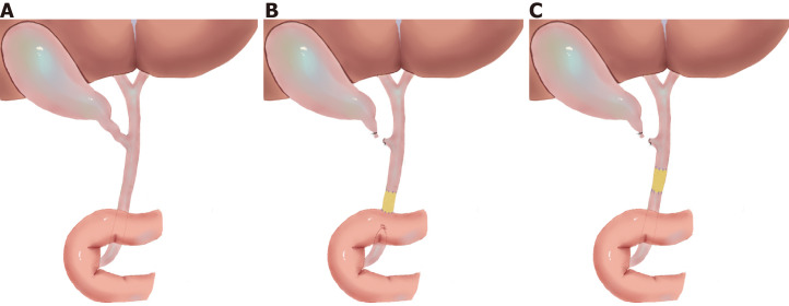 Diagrams of common bile ductal injury and repair model. A: Normal extrahepatic common bile duct; B: Injury and repair model of distal common bile duct (group A); C: Injury and repair model of intermedial common bile duct (group B).