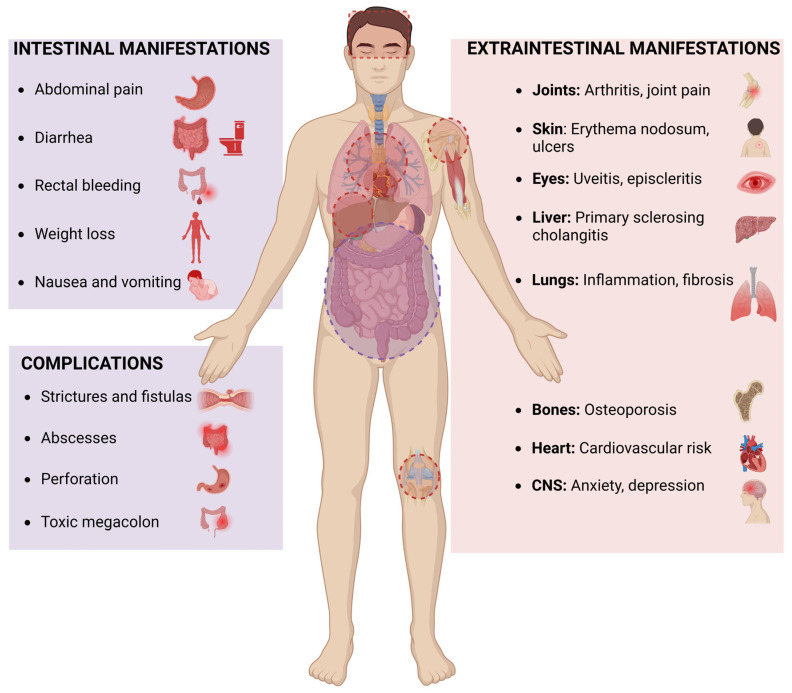 Intestinal and extraintestinal manifestations of inflammatory bowel disease.
