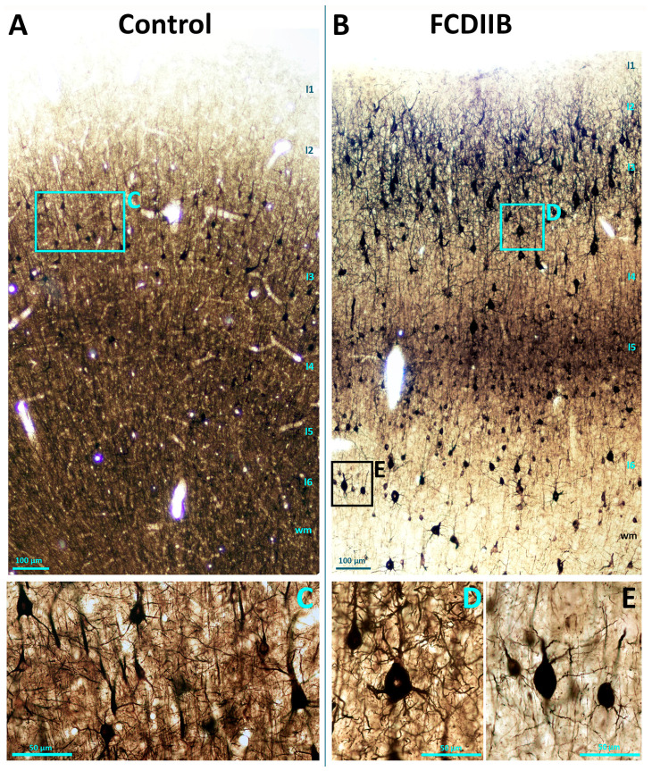 Non-phosphorylated neurofilament H (SMI32)-immunopositive elements in a control sample (A,C) and in an epileptic patient with FCDIIB in frontal cortex (B,D,E). SMI32-immunostaining labels principal cells with high specificity. Control principal cells from layer 3 are shown in the (C) panel. There are numerous giant (presumably dysmorphic) neurons throughout the FCD cortex (B), layer 3–4: panel (D), white matter: panel (E). These giant neurons have abnormally thick and numerous dendrites as well as thin, irregular processes (D,E). Scales: (A,B) 100 µm; (C–E) 50 µm.