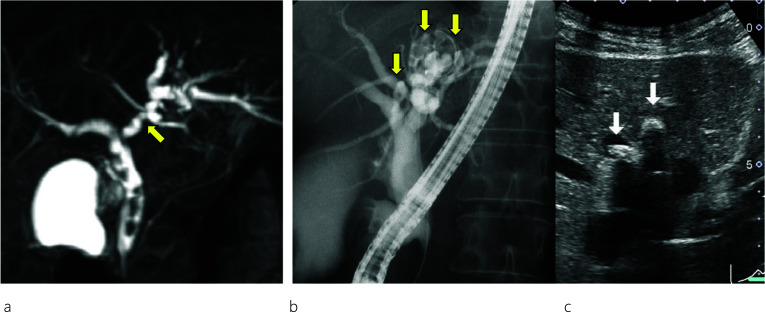 Image findings. Magnetic resonance cholangiopancreatography (MRCP) (a) shows common bile duct (CBD) stones and stenosis at the confluence of B2 and B3. Endoscopic retrograde cholangiopancreatography (ERCP) (b) reveals intrahepatic bile duct (IHBD) stones in B2 and B4 (yellow arrows). Abdominal ultrasound scan (c) shows IHBD stones in B2 and B4 (white arrows)