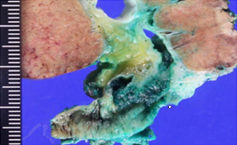 Macroscopic ﬁndings showed a papillary tumor of the bile duct (arrowhead).