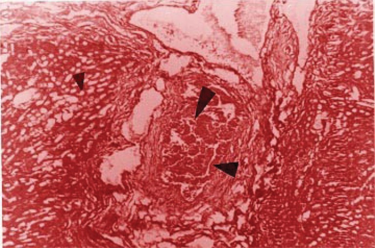 Intracolangiolar biliary thrombus (large arrow) with concentric connective proliferation, epithelial duct fold (medium arrow) and steatosis features (small arrow).