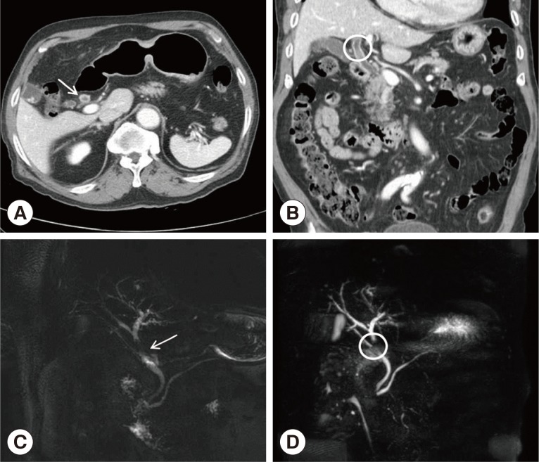 CT and MRCP findings of intraductal lesion of the present patient. (A) CT showing the segmental common hepatic duct wall thickening (white arrow). (B) Intraductal soft tissue lesion in the common hepatic duct without definite evidence of duct obstruction (white circle). (C, D). MRCP revealing intraductal filling defect of the mid-portion of the common bile duct (white arrow and circle).