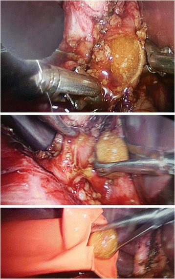 Choledocotomy technique and extraction of big CBD stone