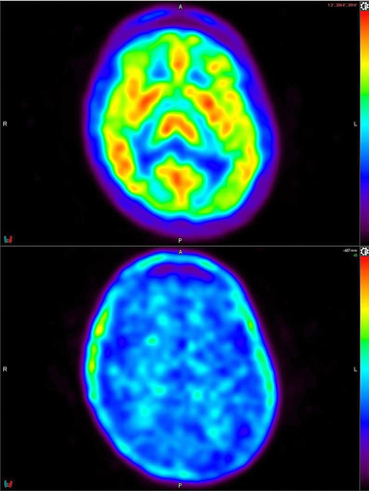 Distribution of [11C]MK3168 in human brain under baseline and blocked conditions. Top image: [11C]MK3168 PET scan at baseline; Bottom image: [11C]MK3168 PET scan in the same volunteer after receiving 10 mg JNJ‐42165279.