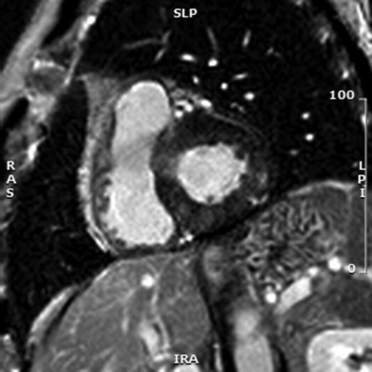 Cardiac magnetic resonance, post-contrast image, basal short axis view, showing non-ischaemic late gadolinium enhancement in the basal inferolateral wall.