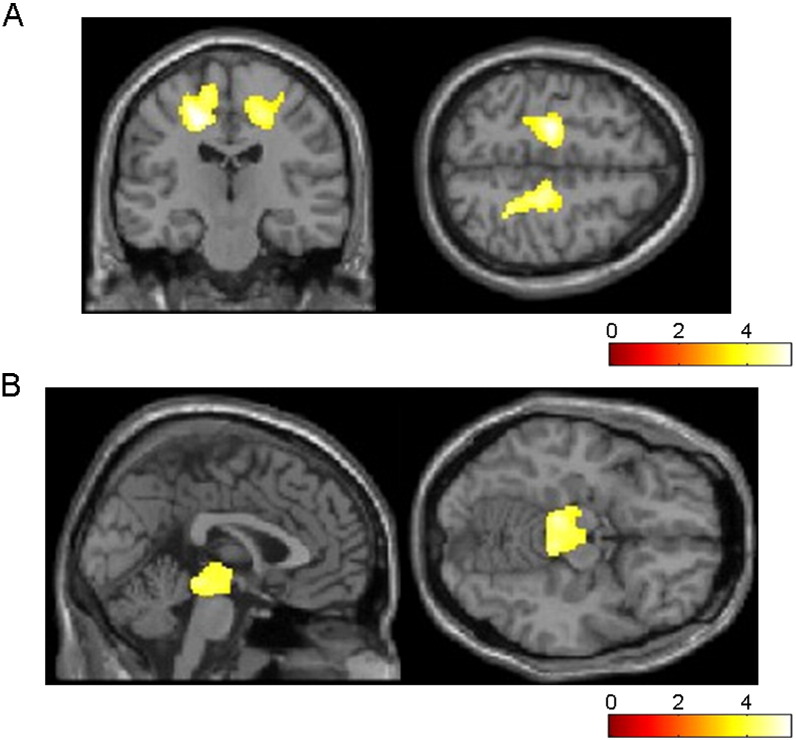 Regions of WM reduction in CBS (A) and RS (B) patients relative to the others. More atrophic lesions are found in 9 CBS patients than in 17 RS patients, especially in the bilateral cingulate, right postcentral, and right middle frontal gyrus (A). On the other hand, significant atrophy is observed in the bilateral midbrain in RS patients (B). Significance maps of WM reduction in CBS and RS patients are superimposed on a T1-weighted brain MRI template image in the Montreal Neurological Institute space. The color bar represents the t value.