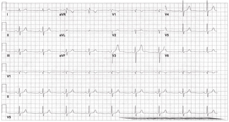 EKG done at 08:49 on day 1 of admission, showing borderline EKG with sinus bradycardia and incomplete RBBB.EKG = electrocardiogram; RBBB = right bundle branch block