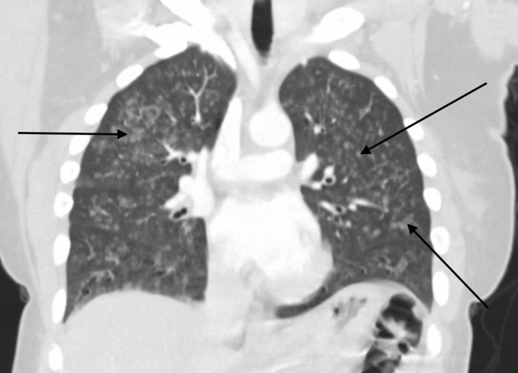 Computed tomography of the chest.Black arrows indicating diffuse ground-glass opacities.