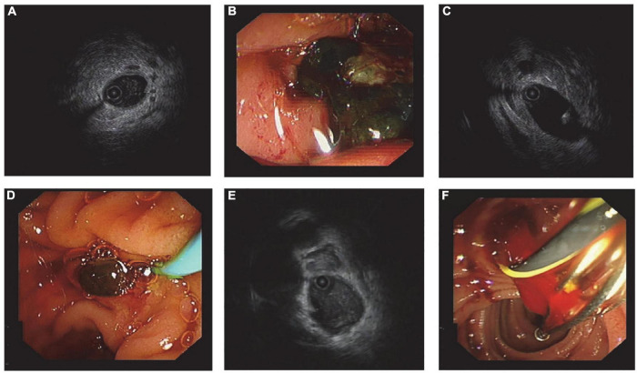 Ultrasonographic and endoscopic images from typical cases. Patient 1: (A) IDUS showed flocculent echo in the lumen; (B) the thick bile was the cause of acoustic characteristics. Patient 2: (C) A little arc high-echo with a shadow was found by IDUS, and it was distinguished from the guidewire, which has ripples in the rear; (D) a small stone with a diameter around 3 mm in size was pulled out. Patient 3: (E) Flocculent echo was detected inside the bile duct, which resembled the acoustic feature of sludge; (F) blood clot was taken out from the common bile duct, and that was because blood stream entered backward into bile duct during sphincterotomy.