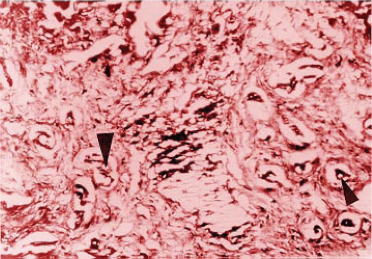 Portally located pseudohamartomatous cholangiolar proliferation (arrow zones).