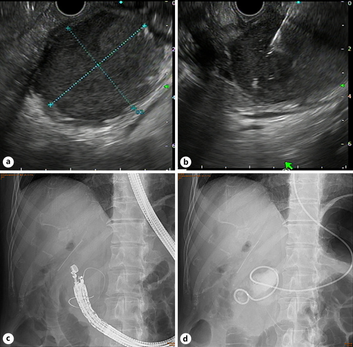 Endoscopic ultrasound-guided transduodenal drainage. a A scan of the duodenal bulb revealed fluid retention with debris inside. b A 19-G needle was punctured for fluid drainage. c A 0.025-in angle-type Jagwire was advanced into the fluid retention site. d A 6-Fr ENAD tube was placed.