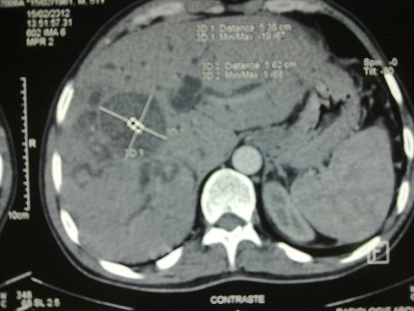 Abdominal CT showing hydatid cyst of 4th & 5th segments of liver communicating wit dilated CBD