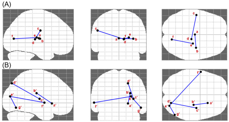 Comparisons of functional connectivity between the patient and healthy control groups. Significantly different functional connectivity between brain regions are displayed on the glass brain template (SPM–NBS) as links joining the corresponding functional nodes. (A) Patients with substance use disorders exhibited higher functional connectivity between the medial thalamus (a) and the posterior insula (b), higher functional connectivity between the somato-motor region of the inferior central sulcus (c) and the posterior thalamus (d), and higher functional connectivity between the globus pallidus (e) and the cuneus (f). (B) The control group demonstrated increased functional connectivity relative to the patients between the anterior putamen (anterior capsule limb, a′) and the posterior corona radiata (superior longitudinal fasciculus, b′), within the visual cortices (superior, e′, and inferior occipital gyrus, g′) and the contralateral superior temporal gyrus (f′), and between the superior occipital gyrus (superior part, d′) and the posterior insula (c′).