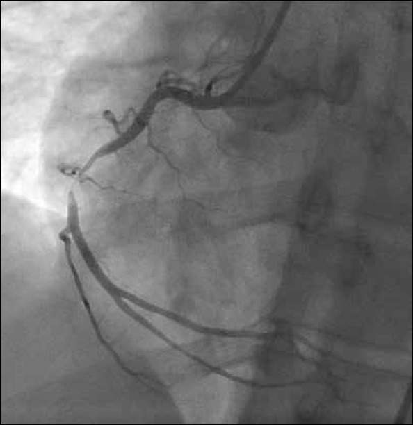 Thrombotic stenosis in mid-RCA in the left anterior oblique position