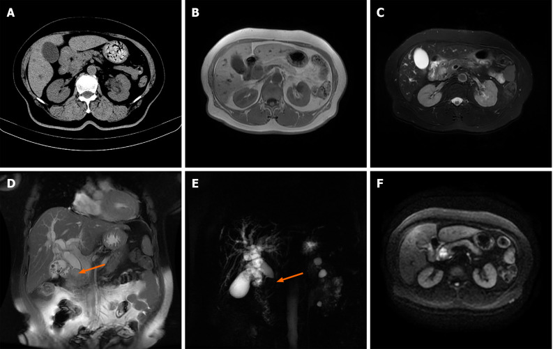 Imaging revealed calculous cholecystitis, intrahepatic and extrahepatic bile duct dilation with extrahepatic bile duct calculi, and a space-occupying lesion of the distal common bile duct. A: Computed tomography showed calculous cholecystitis, and a soft tissue density shadow at the distal common bile duct (CBD) with intrahepatic and extrahepatic bile duct dilatation; B-F: Magnetic resonance imaging by the (B) T1-weighted image, (C) T2-weighted image, (D) coronal plane sequence, (E) magnetic resonance cholangiopancreatography and (F) diffusion-weighted imaging revealed calculous cholecystitis, intrahepatic and extrahepatic bile duct dilation with extrahepatic bile duct calculi, and a soft tissue mass signal at the distal CBD with limited diffusion.