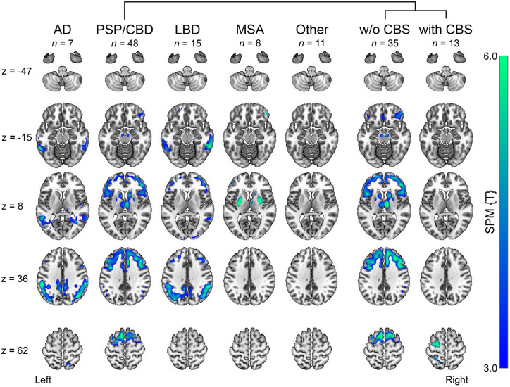 Groupwise patterns of cerebral hypometabolism. [18F]FDG PET scans supporting interdisciplinary consensus diagnosis were compared with 13 healthy controls (false discovery rate–corrected P < 0.05, cluster extent k > 100 voxels). Significant clusters are overlaid on MRI template. [18F]FDG PET scans were available for all patients except for 4 classified as AD or PSP/CBD. Patients with FTD (n = 3) and LBD subgroups without and with dementia are shown in Supplemental Figure 2. SPM {T} = statistical parametric mapping T value; w/o = without; z = slice number.