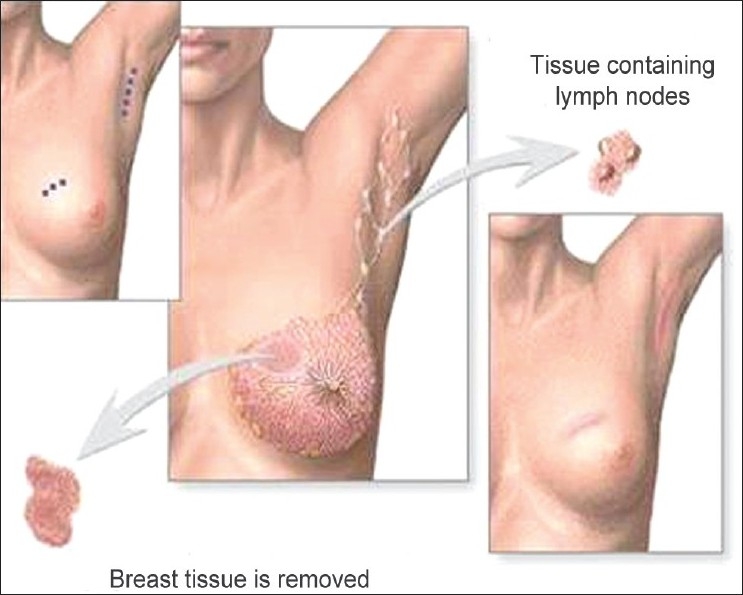 Breast conservation surgery
