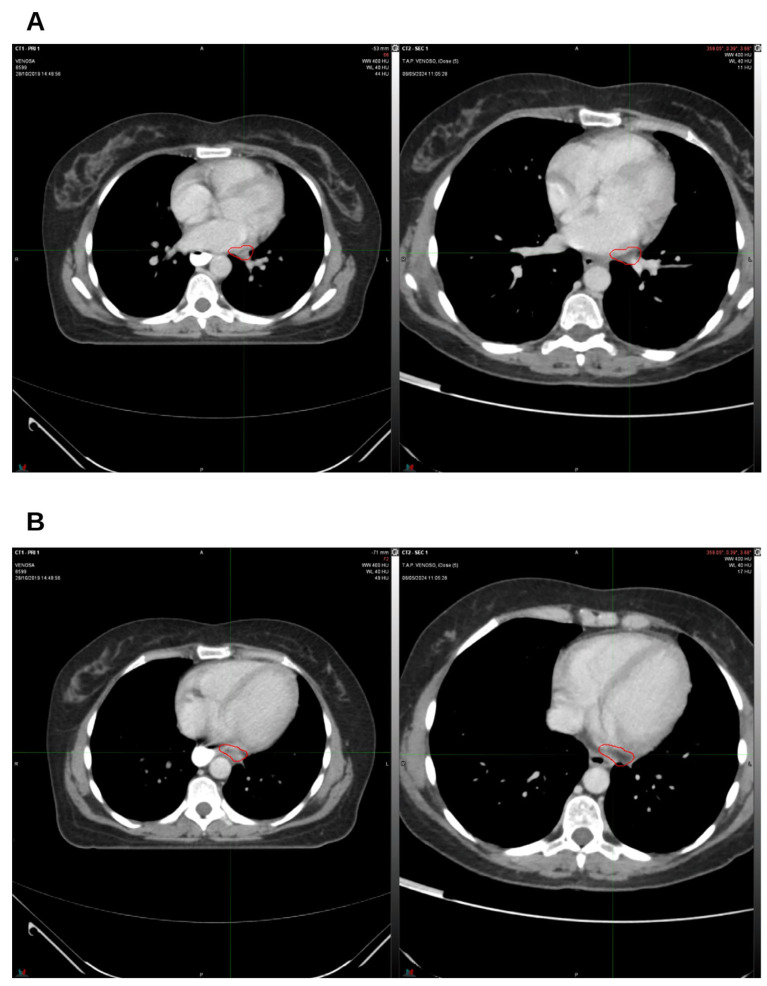 The last follow-up. On the left, CT from October 2019, pre-radiation therapy treatment; on the right, CT from May 2024. (A) Hilar lymph node; (B) left para-aortic lymph node. The indicated region highlights the boundary of the treated target.