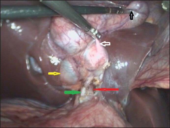 Anatomy after initial dissection with traction on fundus (black arrow) and Hartman's pouch (white arrow) of 1st lobe, showing partially intrahepatic 2nd lobe (yellow arrow) and solitary cystic duct (green arrow) and artery (red arrow)