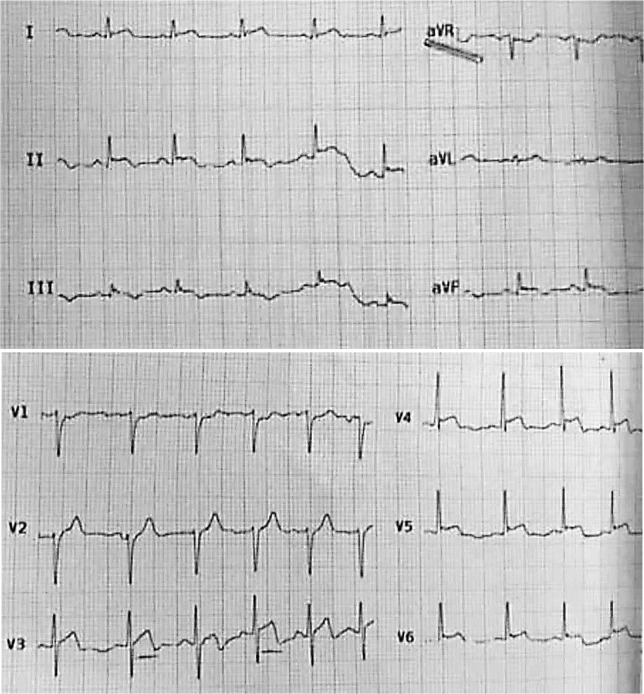 Initial electrocardiogram with ST elevation in inferior (with biphasic T wave) and V3 to V6 leads and also, ST segment sublevel in aVR lead