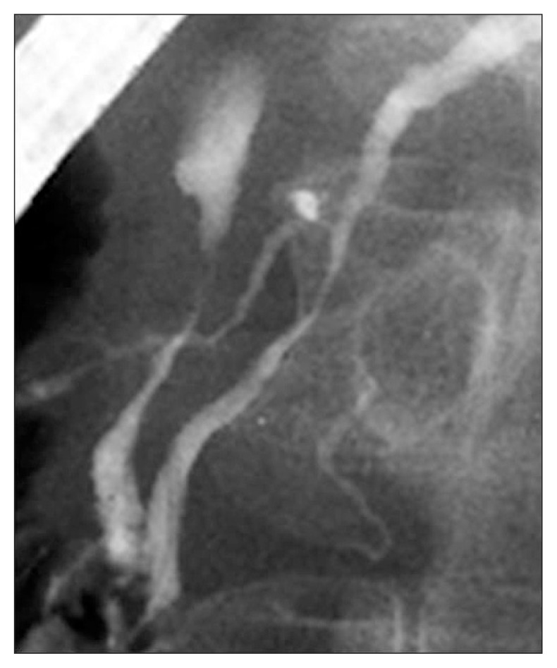 Endoscopic retrograde pancreatography findings of excluded cases showing no irregular narrowing of the main pancreatic duct within 2 cm from the orifice.