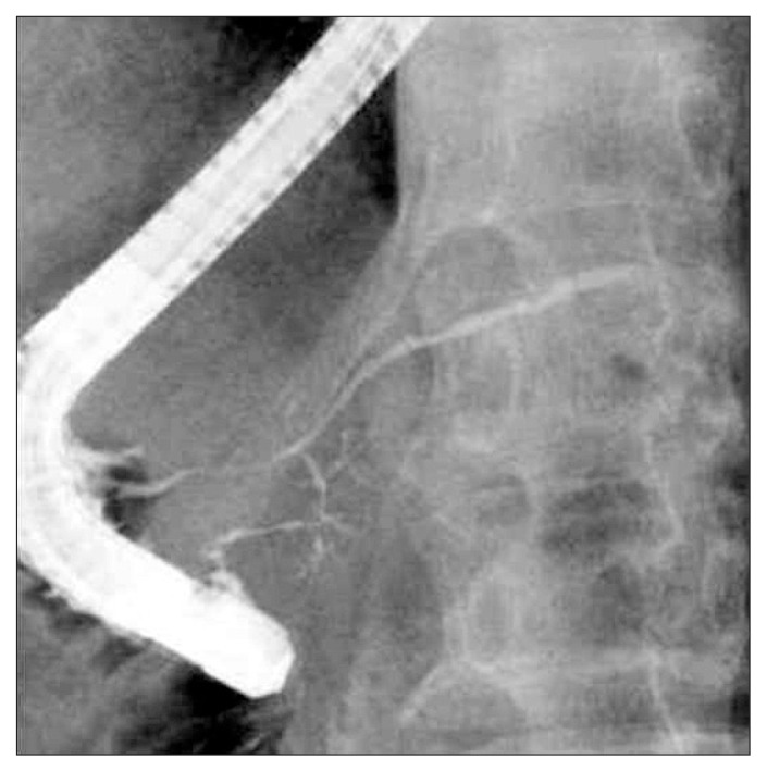 Endoscopic retrograde pancreatography finding of diffuse narrowing of the main pancreatic duct involving the orifice in the major papilla.