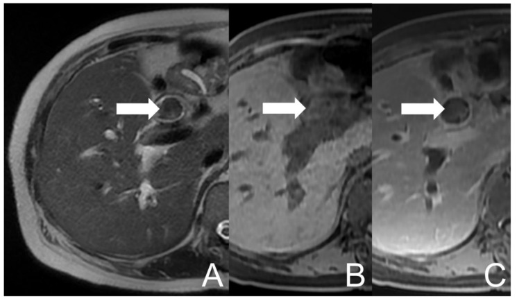 UCOGC of CHD and CBD in a 66-year-old female. The initial axial MRI images show a mass (arrow) with heterogeneous signal intensities in CBD, demonstrating relatively low signal intensity on the T2-weighted image (A) and relatively high signal intensity on the pre-contrast T1-weighted fat-saturated image (B), with faint enhancing foci on the post-contrast T1-weighted fat-saturated image (C). The imaging findings are suggestive of a neogrowth with hemorrhage.